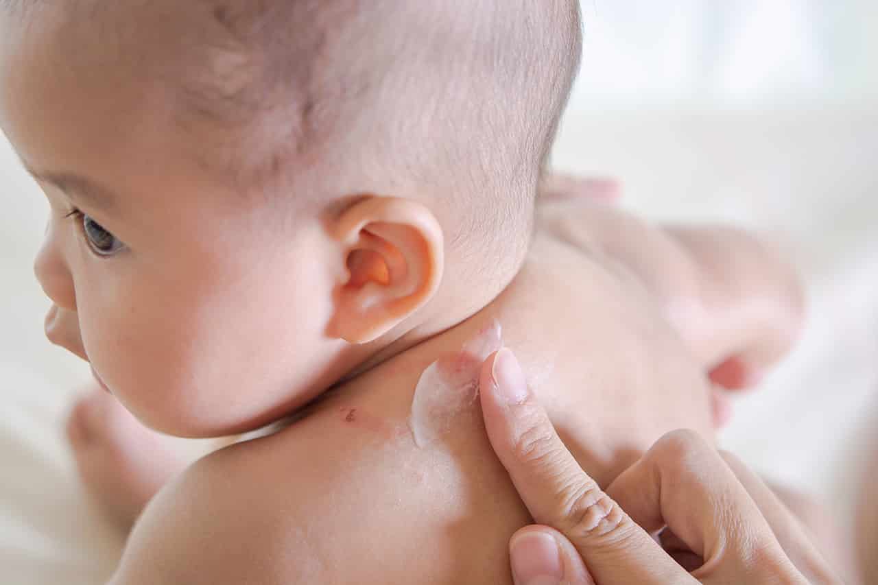 赤ちゃんの虫刺され対策とは 刺された場合の対処法もご紹介 Fam S Baby