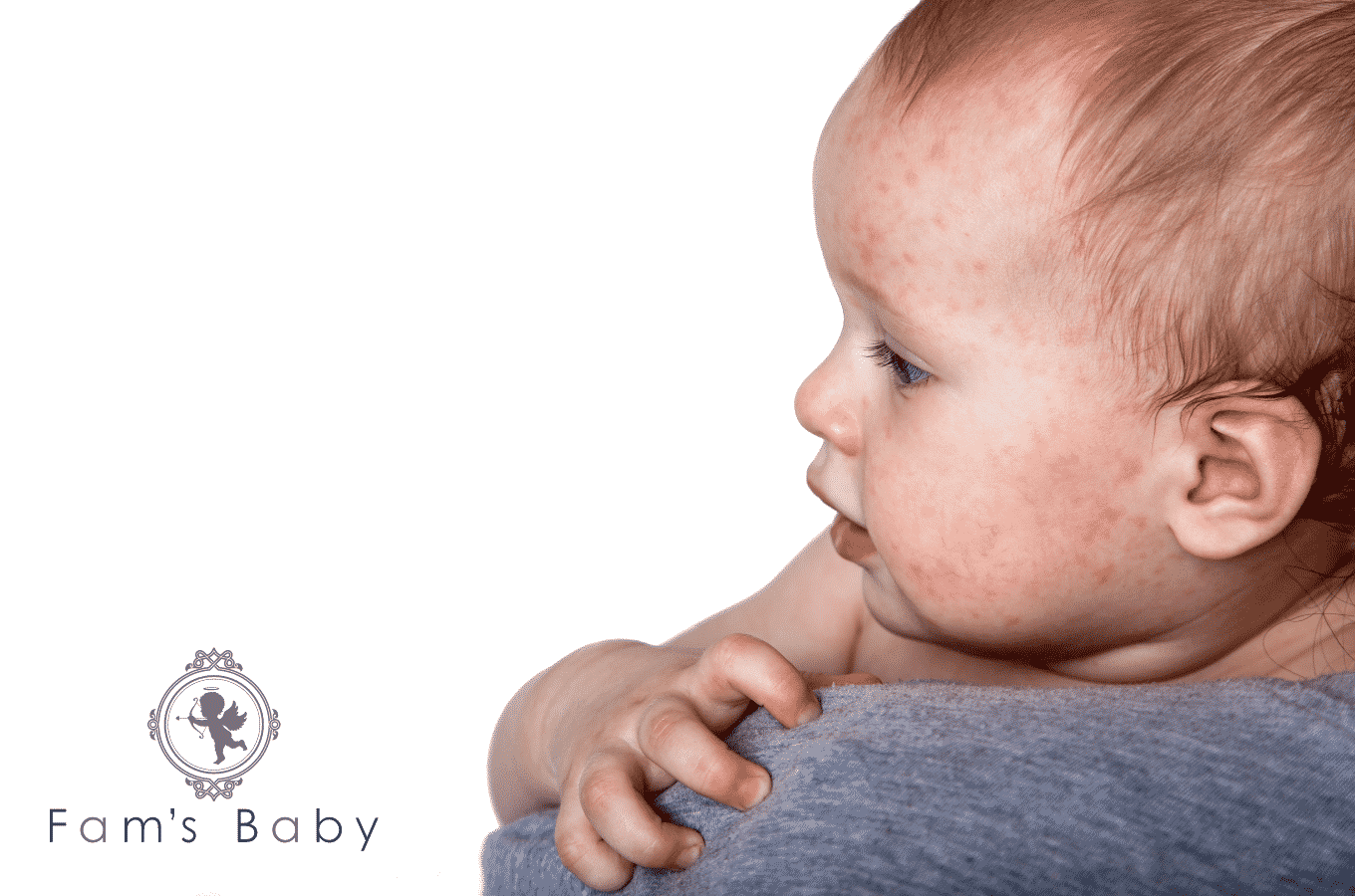 赤ちゃんのアトピー性皮膚炎とは 症状や治療法 ホームケアについて解説 Fam S Baby