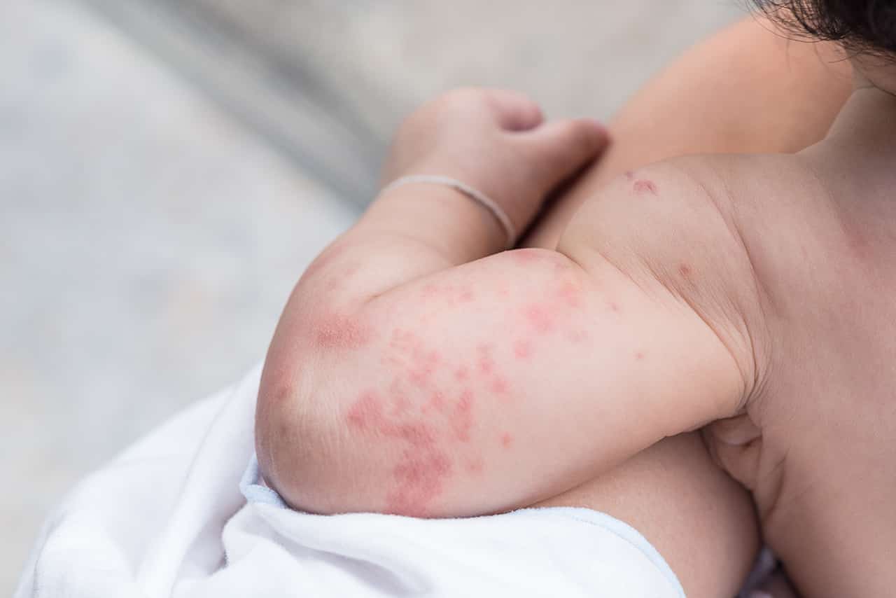 赤ちゃん 蚊 に 刺され た 赤ちゃんに蚊に刺されたような赤く腫れた発疹が 効いた薬